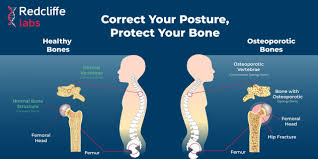 Bone Health and Osteoporosis