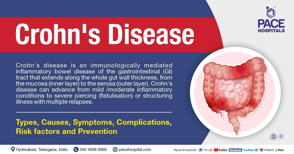 Definition & Facts for Crohn’s Disease